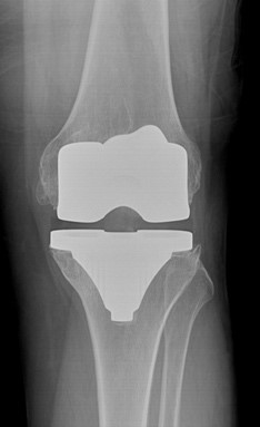 Knee Osteotomy Surgery | One Hatfield Hospital | Hertfordshire