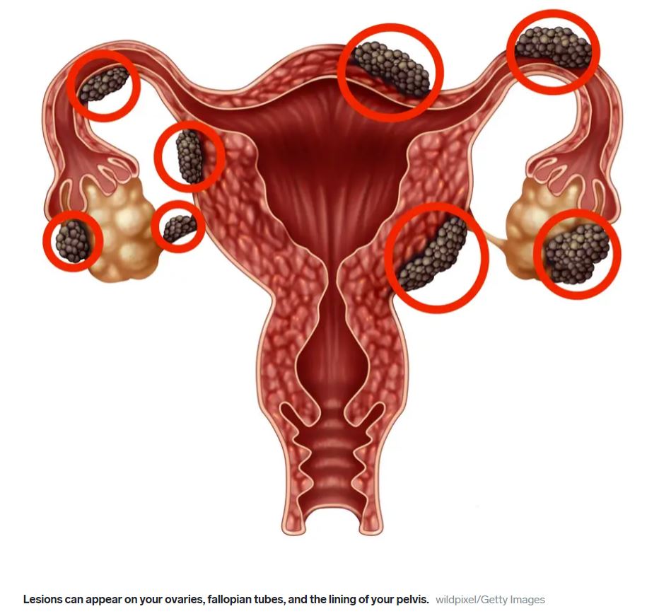 Symptom of endometriosis, menstrual blood with blood clots on a