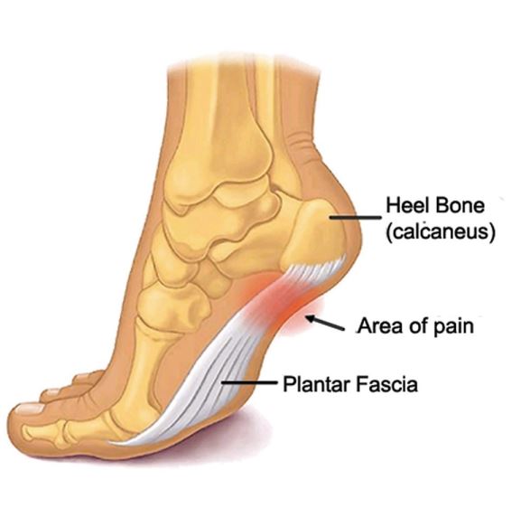 Treatments for Heel Pain | Boca Raton Foot Care
